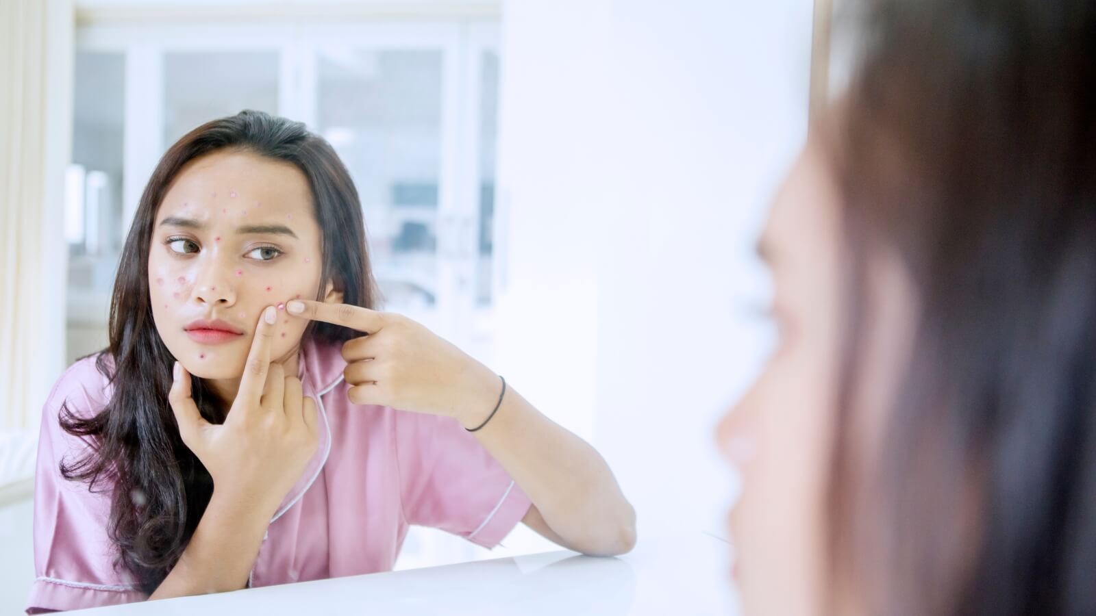 Da nổi nhiều mụn là một dấu hiệu rối loạn nội tiết tố nữ