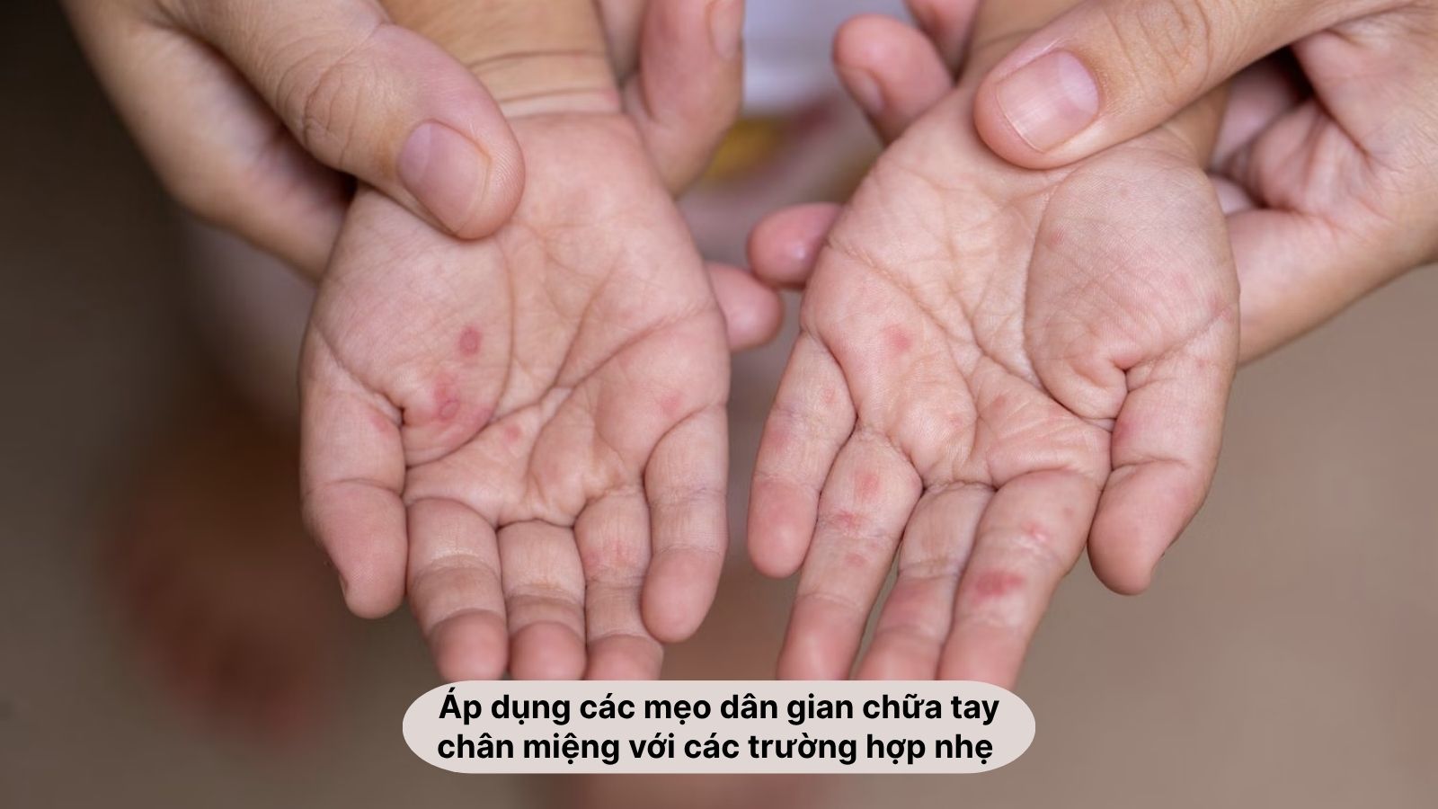 Mẹo dân gian chữa bệnh tay chân miệng an toàn, dễ thực hiện