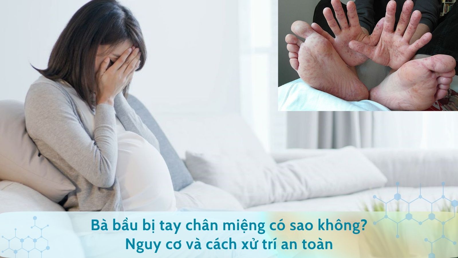 Bà bầu bị tay chân miệng có sao không? Nguy cơ và cách xử trí an toàn