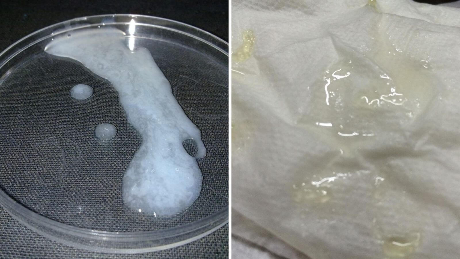 Tinh trùng vón cục là hiện tượng tinh dịch sau khi xuất ra bên ngoài sẽ có tình trạng vón cục, kết lại thành từng cục