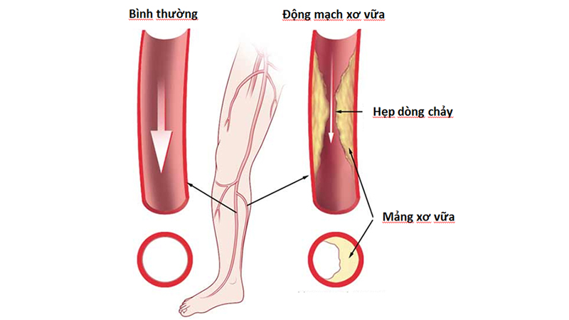 Loét bàn chân gây bệnh động mạch ngoại biên