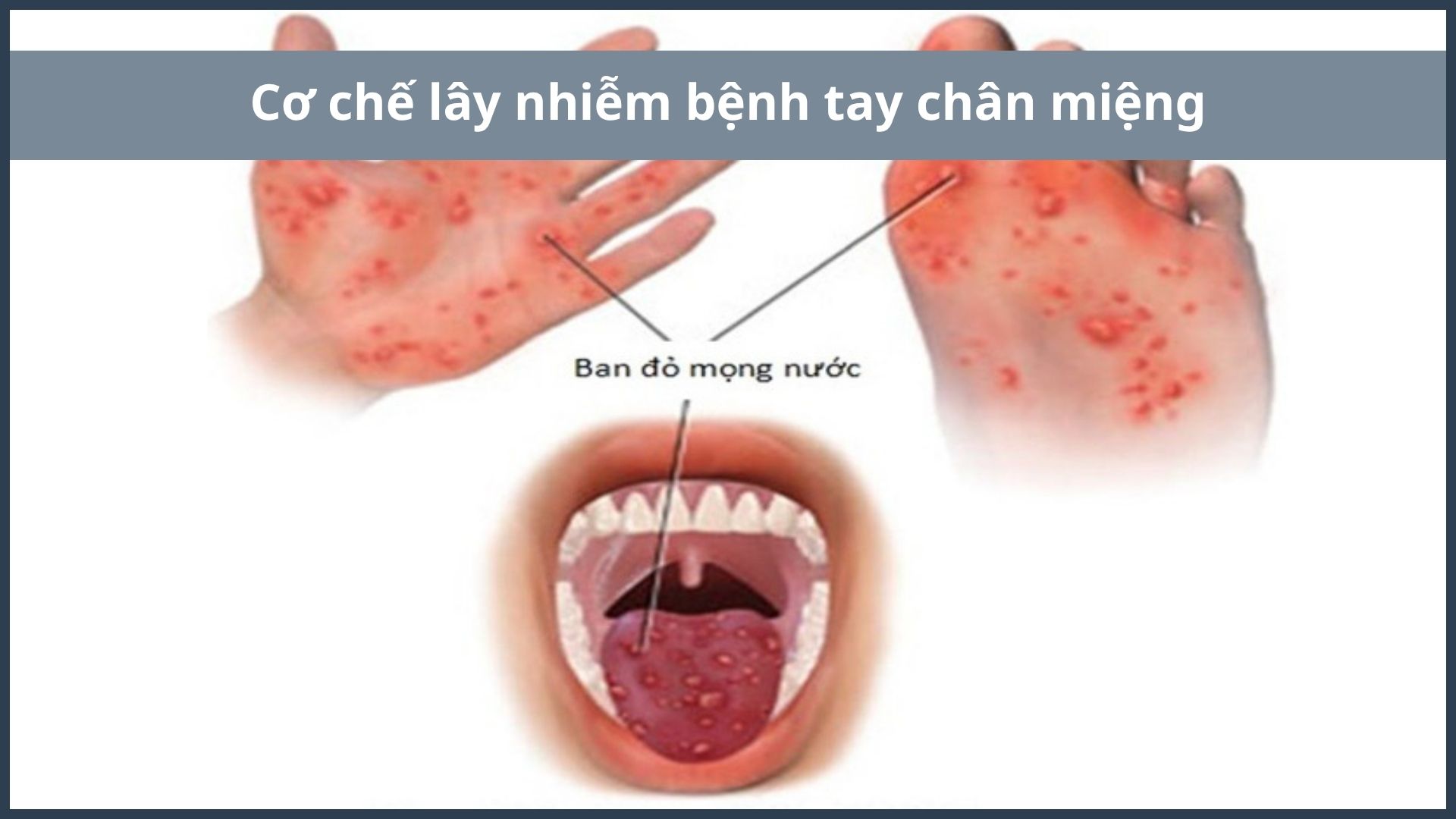 Virus từ các mụn nước dễ phát tán và lây lan cho người khác khi tiếp xúc