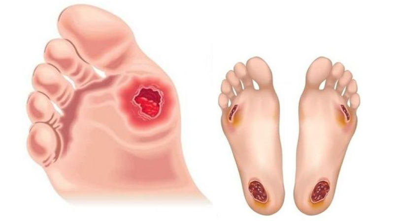 Kiểm tra bàn chân trước khi ngủ để ngăn ngừa biến chứng nguy hiểm ở tiểu đường