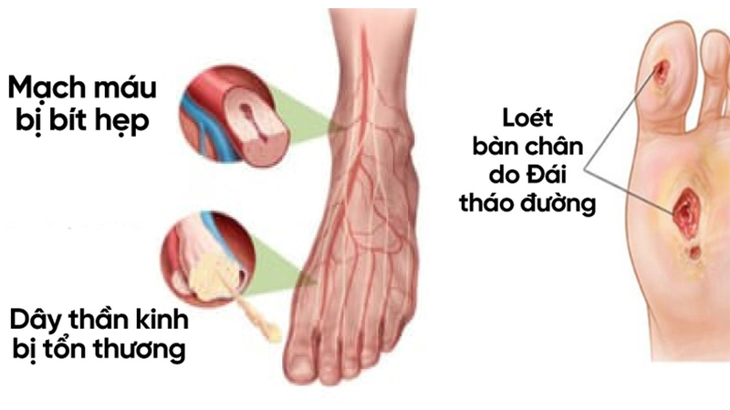 Biến chứng tiểu đường ở chân