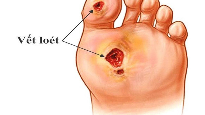 Xuất hiện vết loét là biến chứng tiểu đường ở chân