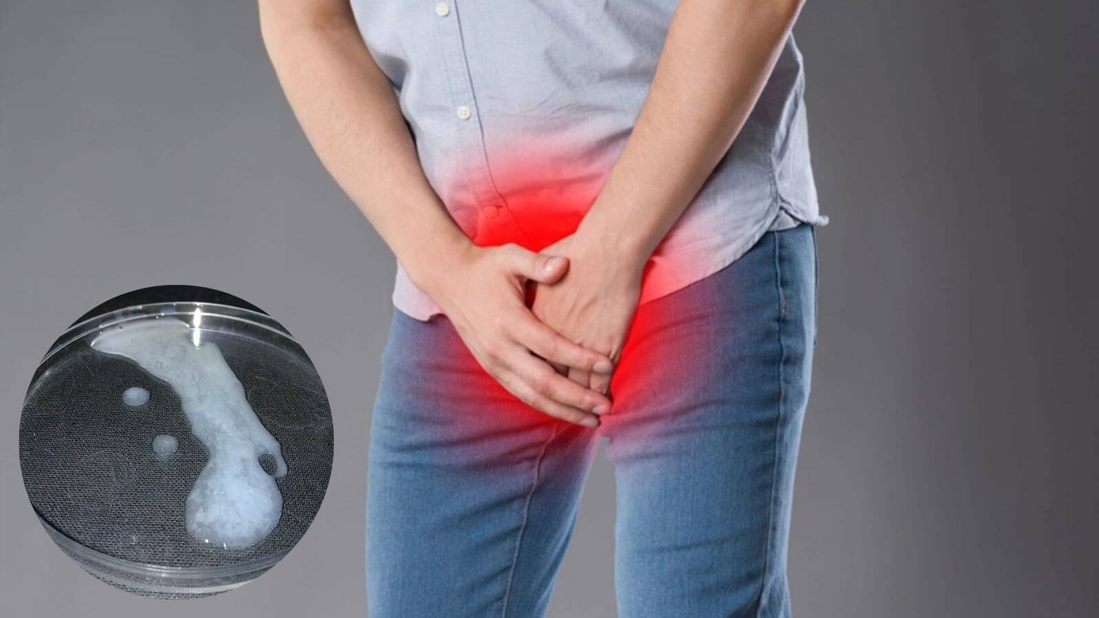 Nhiệt độ quanh tinh hoàn nóng lên dễ khiến tinh trùng bị vón cục