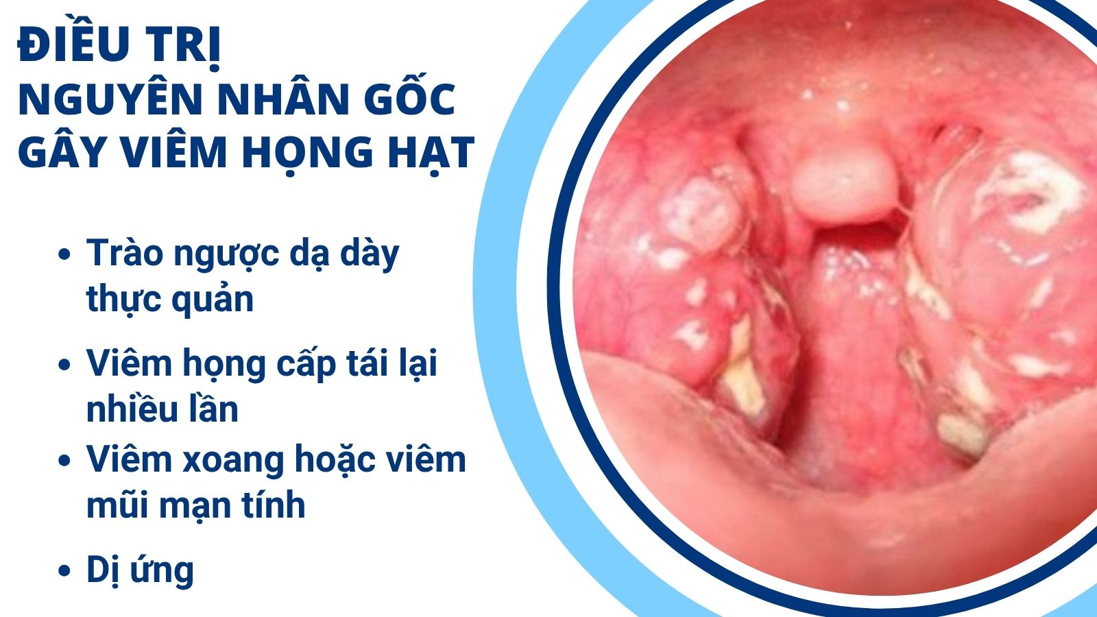 Chữa viêm họng hạt cần điều trị đúng nguyên nhân