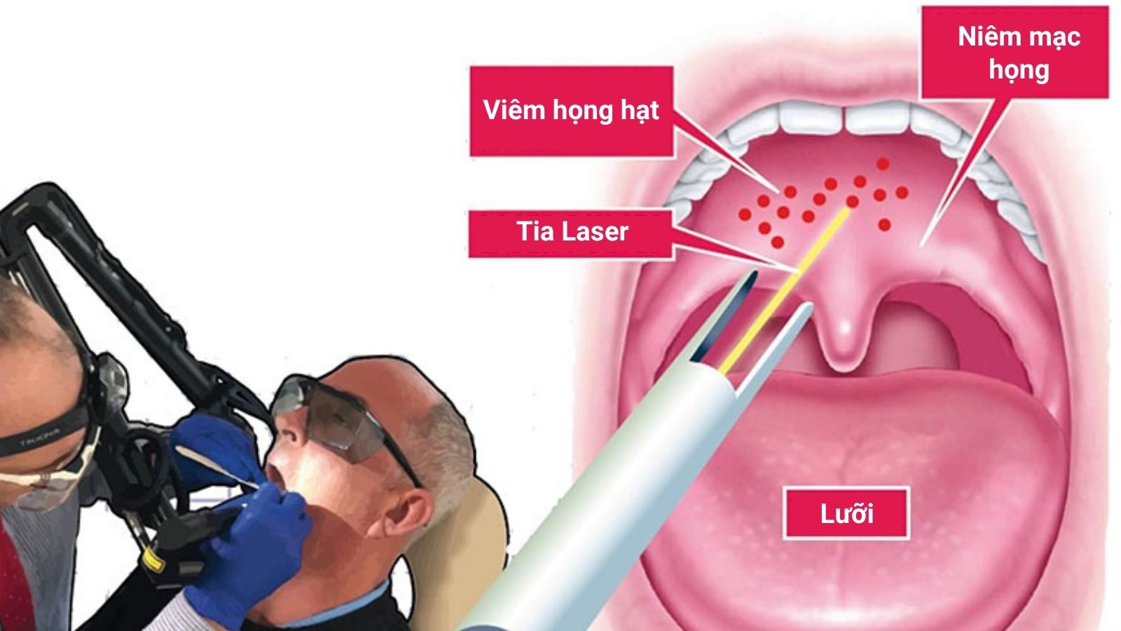 Áp dụng đốt hạt bằng laser khi điều trị nội khoa không hiệu quả