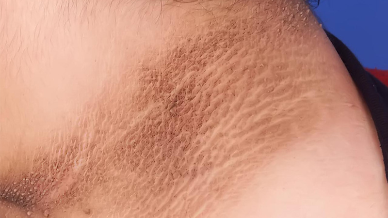 Dấu hiệu giai đoạn tiền tiểu đường