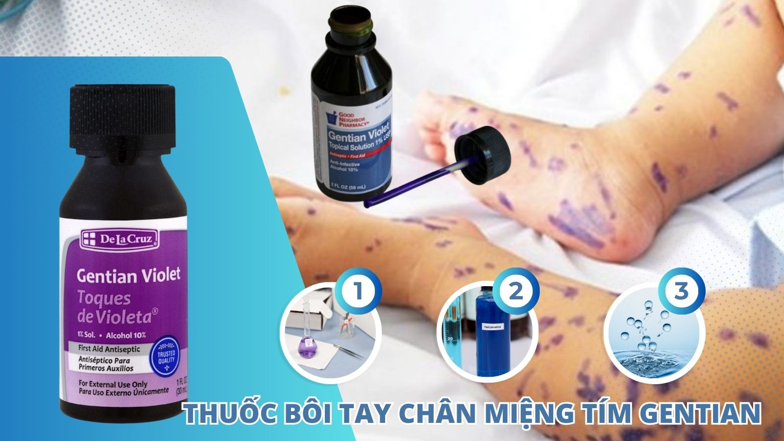 Thuốc tím giúp sát khuẩn, ngăn nhiễm trùng tại nút mụn nước