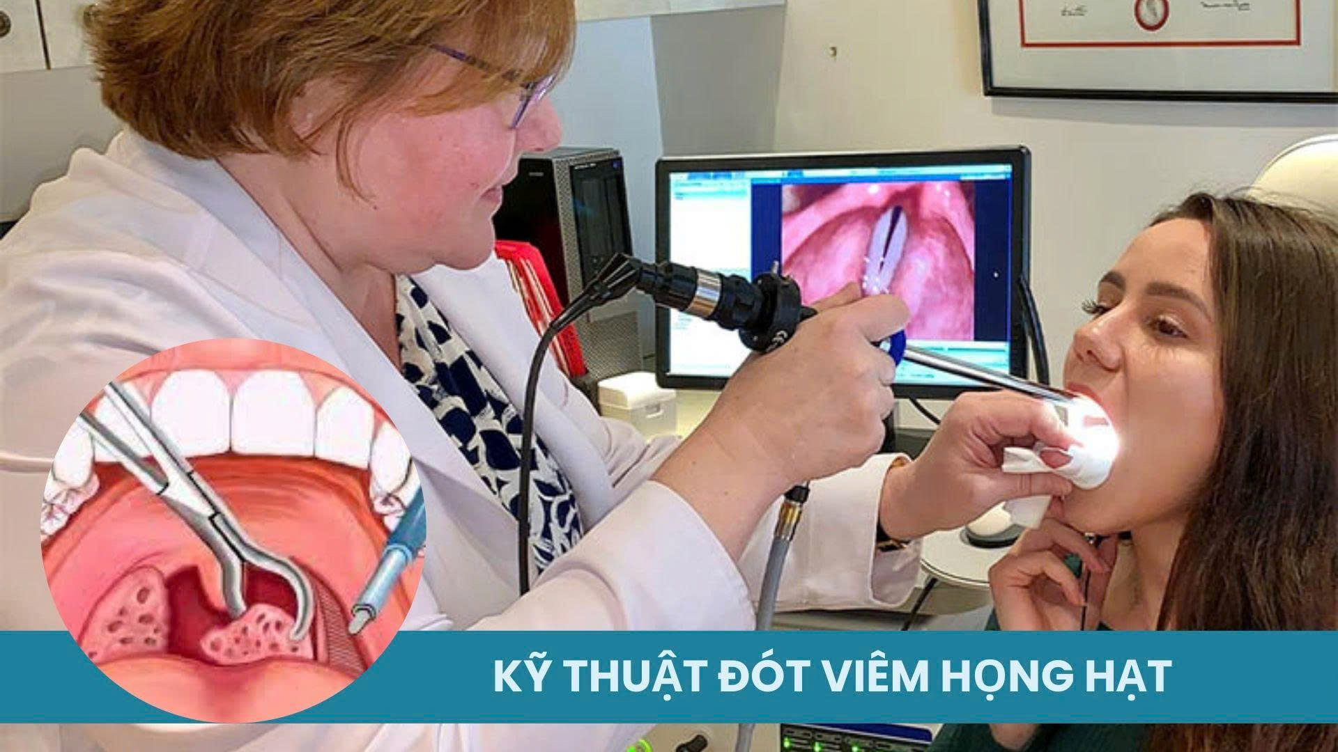 Hiện nay có 4 phương pháp đốt viêm họng hạt phổ biến