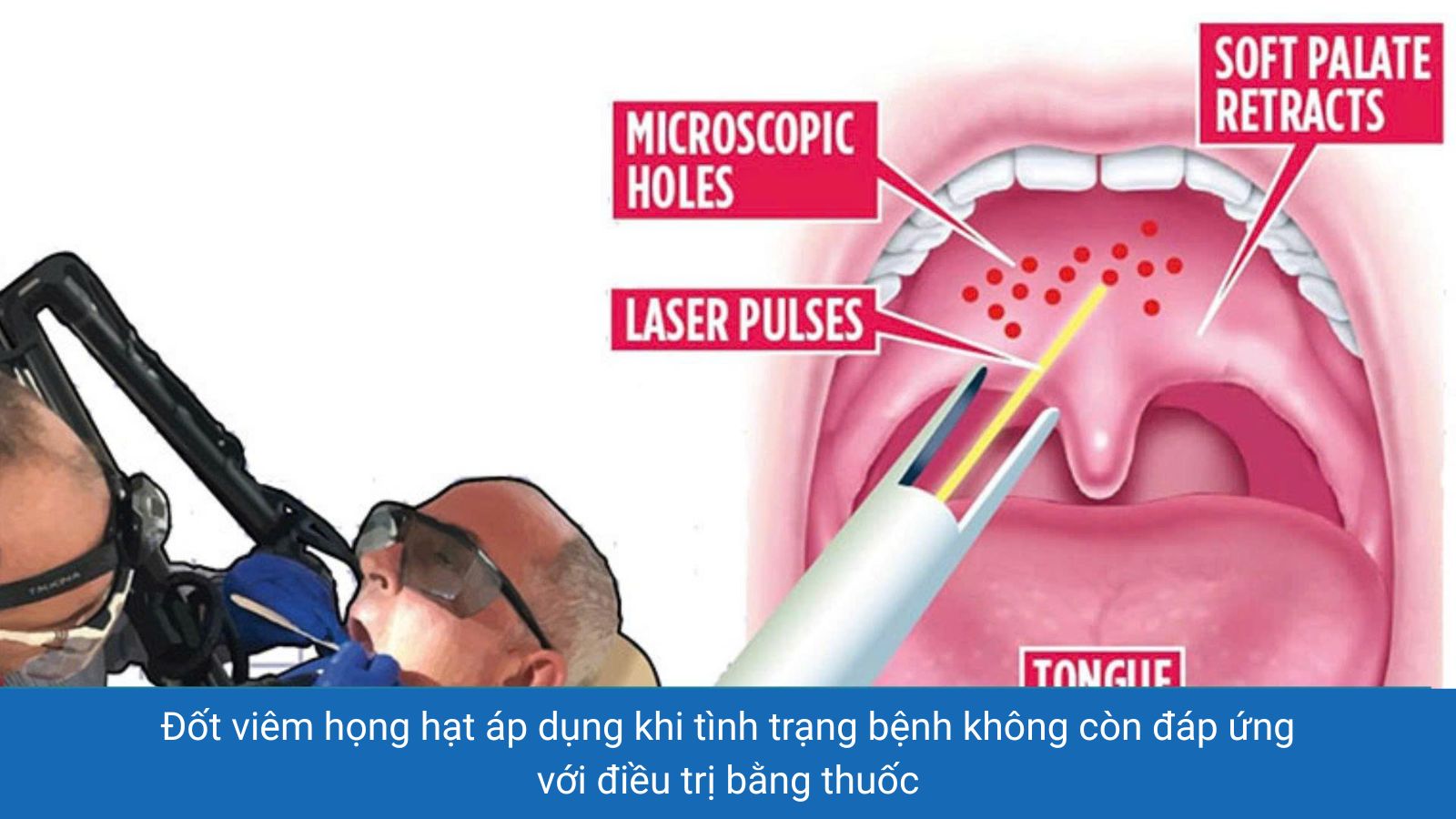 Đốt viêm họng hạt là phương pháp điều trị hiệu quả khi bệnh chuyển sang tình trạng mãn tính, tái phát nhiều lần