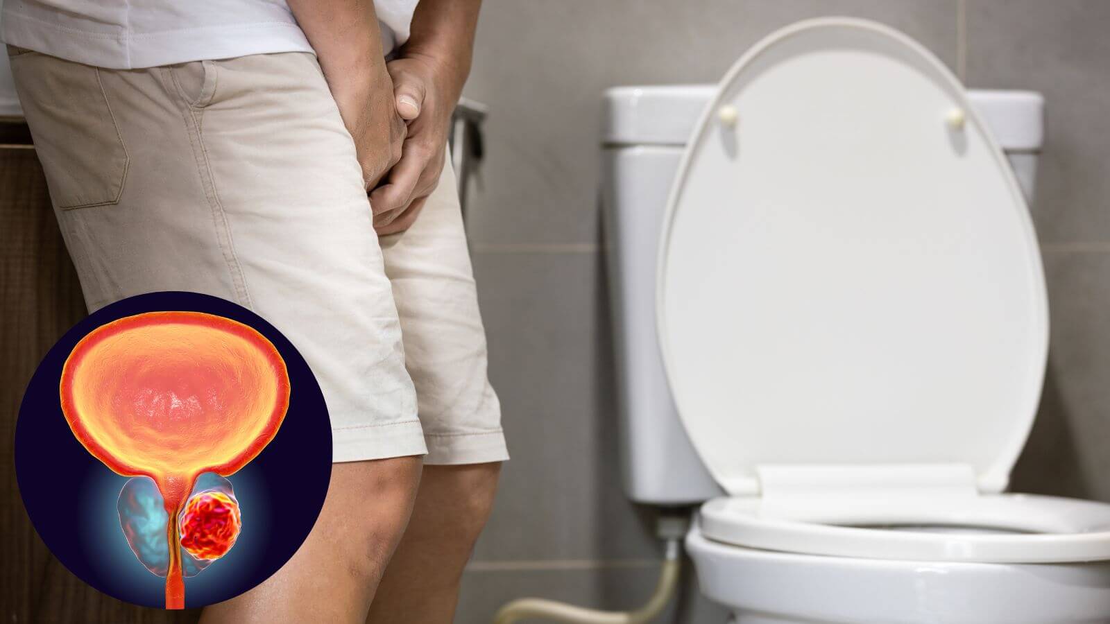 Bất thường khi đi tiểu là biểu hiện của bệnh phì đại tuyến tiền liệt