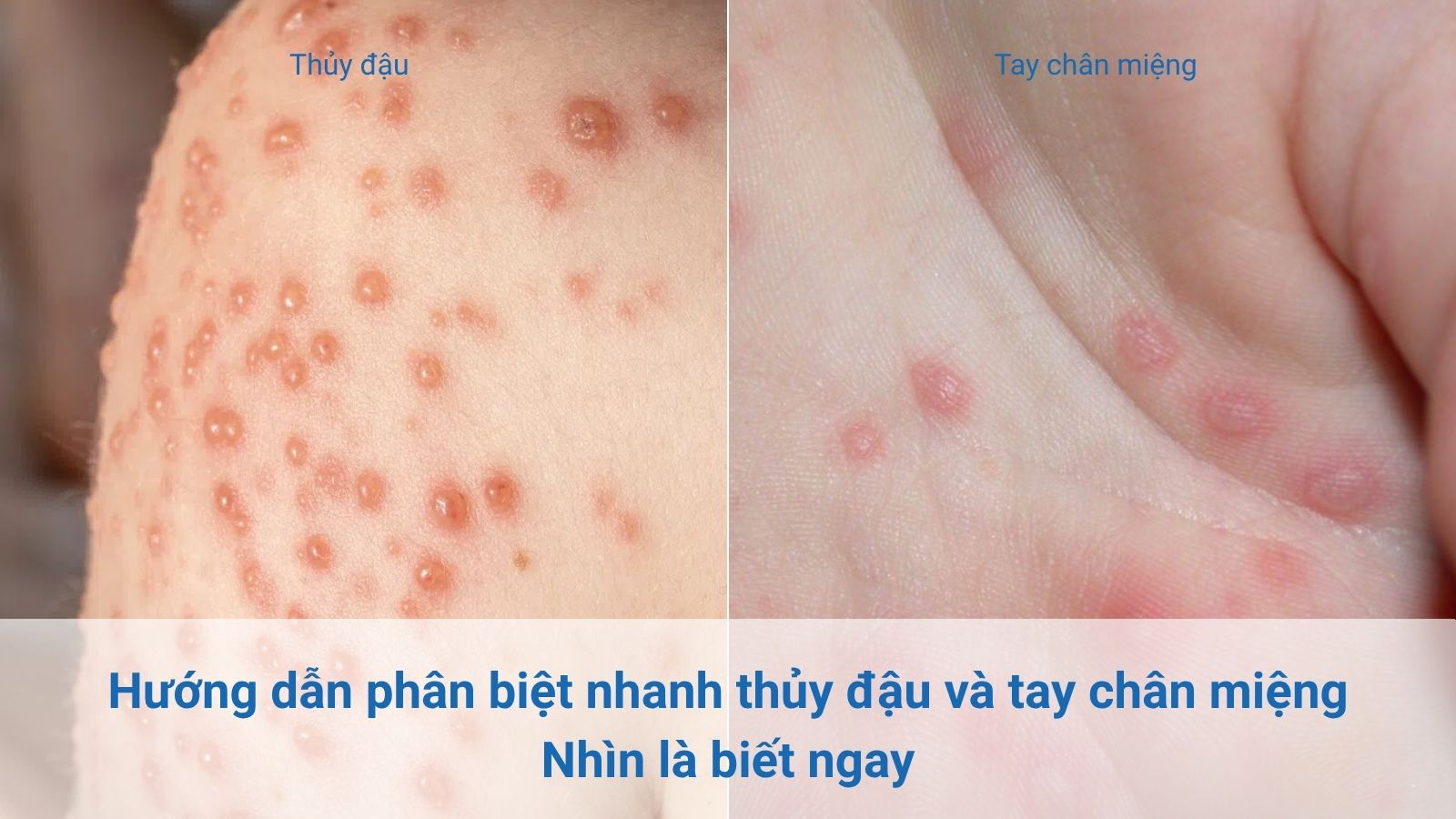 Hướng dẫn phân biệt nhanh thủy đậu và tay chân miệng: Nhìn là biết ngay