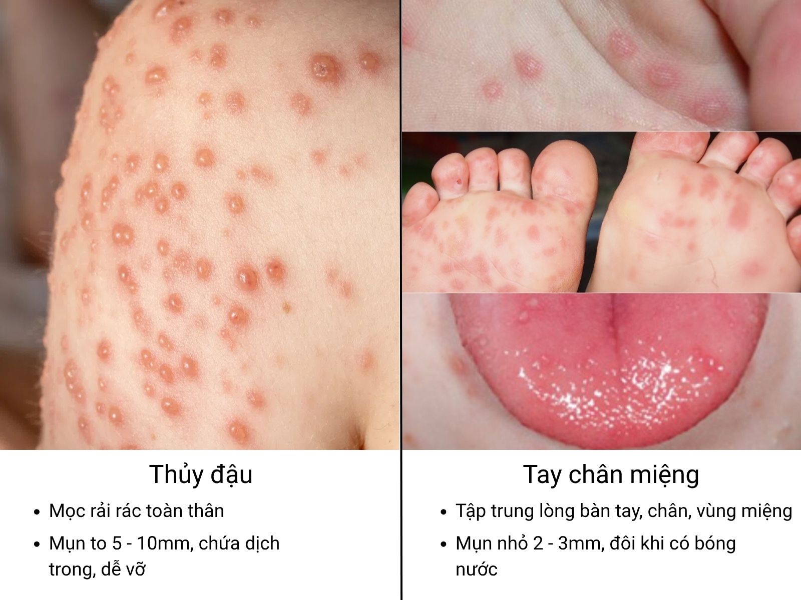 Sự khác biệt giữa mụn thủy đậu và tay chân miệng