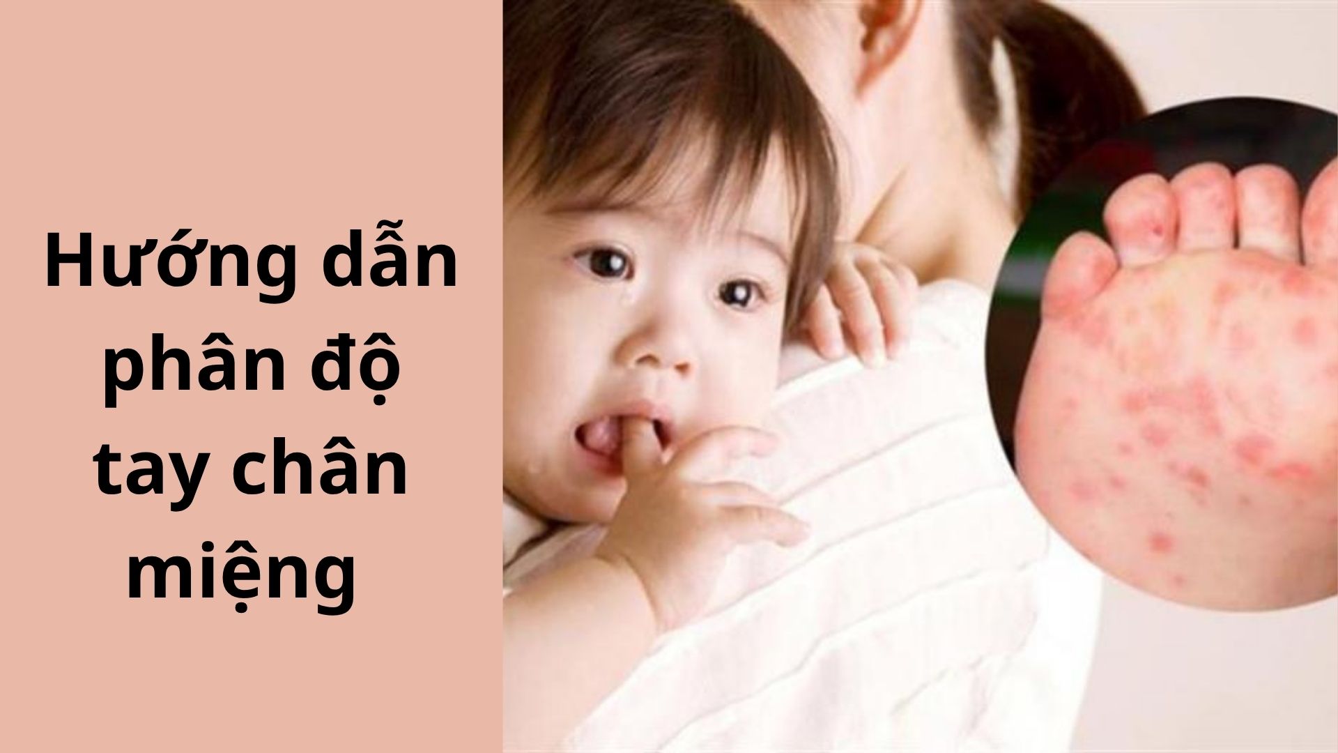 Hướng dẫn phân độ tay chân miệng chuẩn Bộ Y tế: Cha mẹ cần biết
