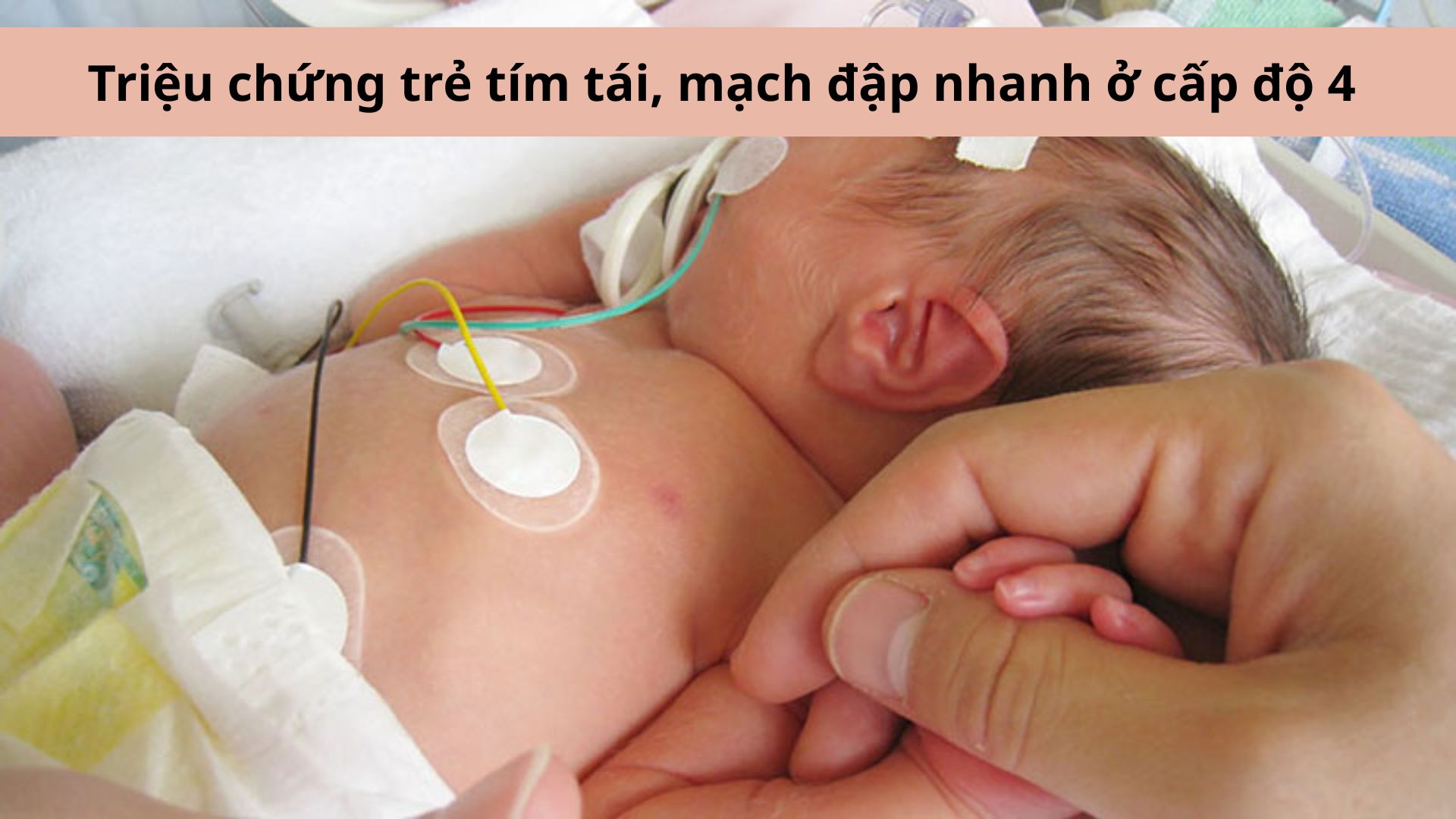 Trẻ bị tím tái, mạch đập nhanh là dấu hiệu tay chân miệng cấp độ 4