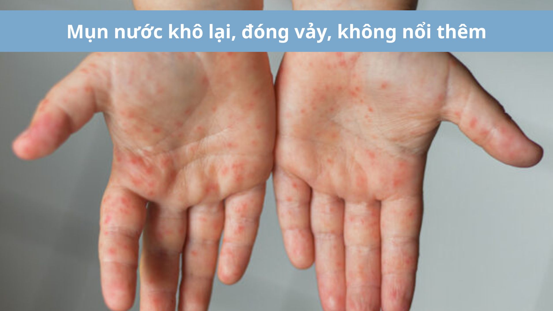 7 Dấu hiệu khỏi bệnh tay chân miệng - Mụn nước bắt đầu khô lại, không nổi thêm