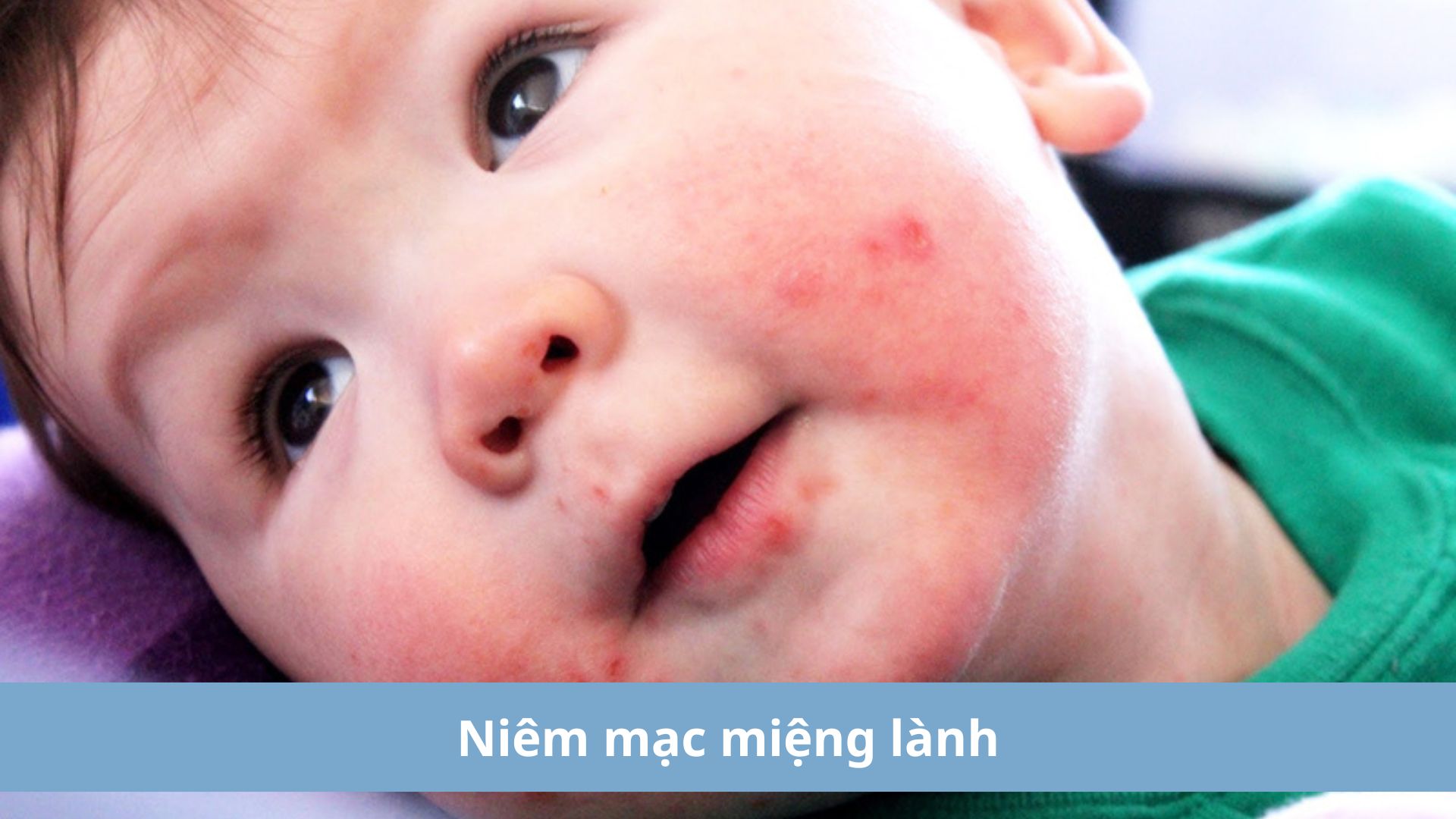 Niêm mạc họng ở trẻ dần lành lại là dấu hiệu bệnh đang thuyên giảm