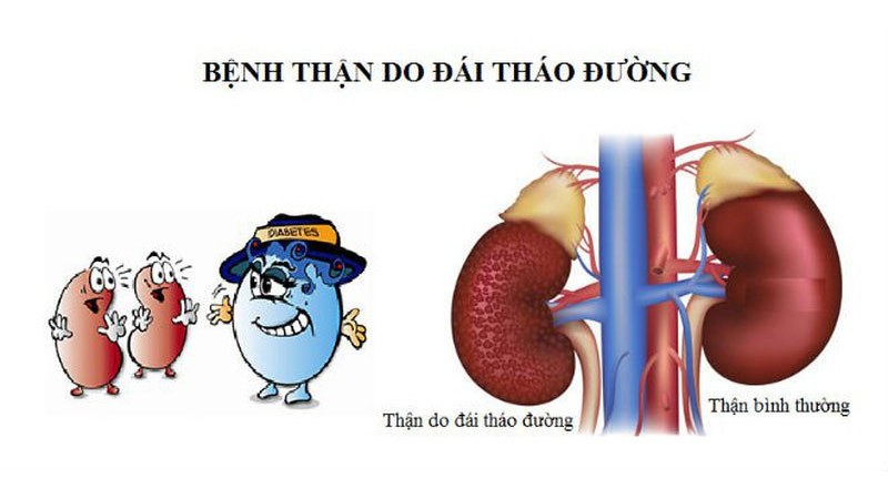 Tiểu đường type 2 có thể gây nên các biến chứng về thận