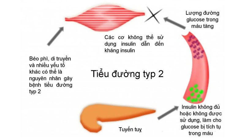 đái tháo đường type 2