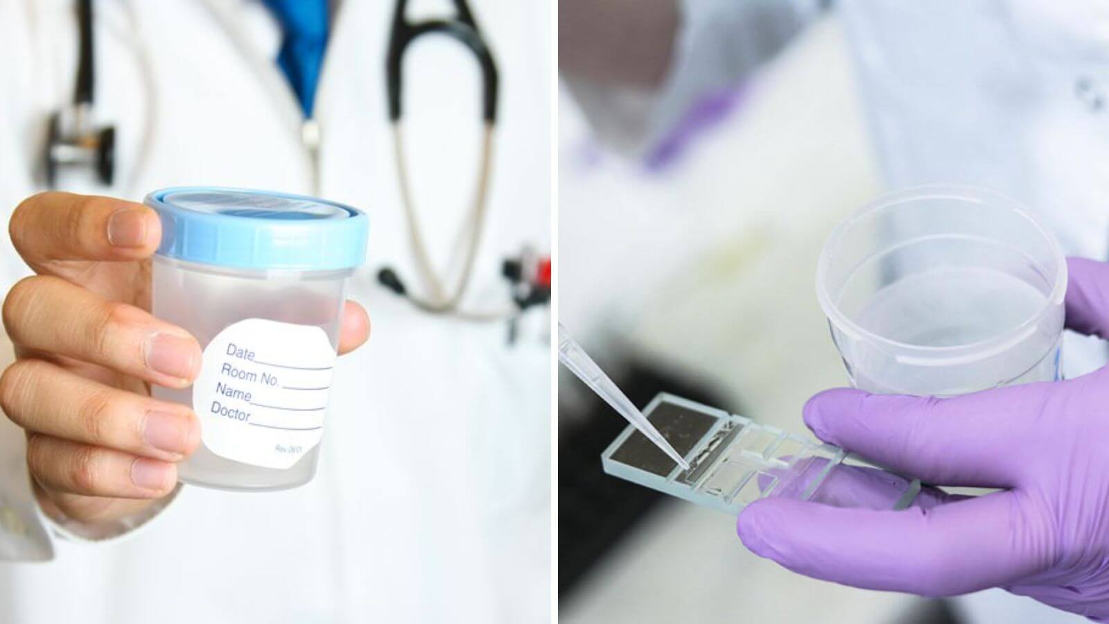 Xét nghiệm tinh dịch đồ sẽ cho biết rõ về tình trạng tinh trùng