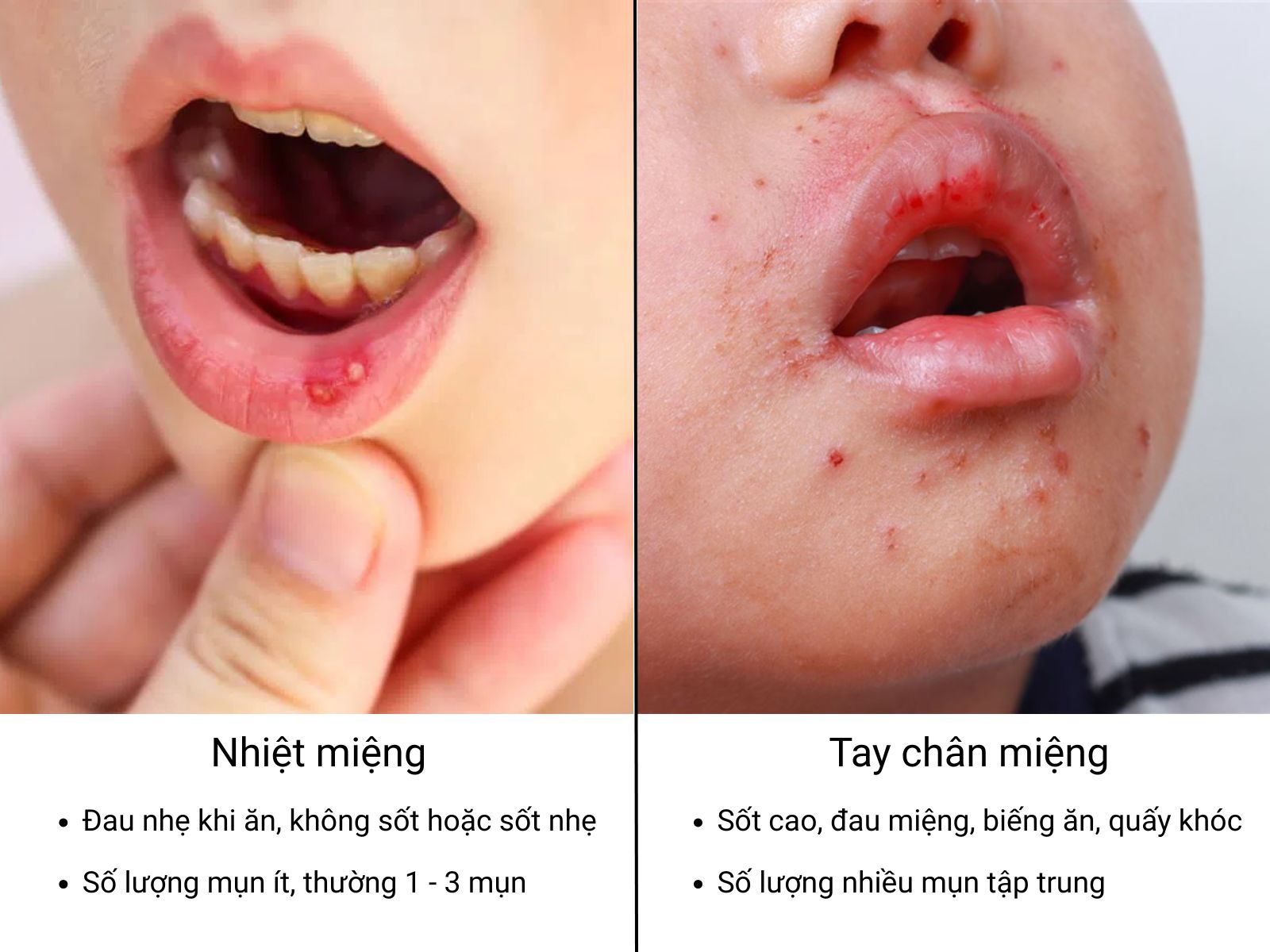 Cả tay chân miệng và nhiệt miệng đều gây cảm giác khó chịu khi ăn uống