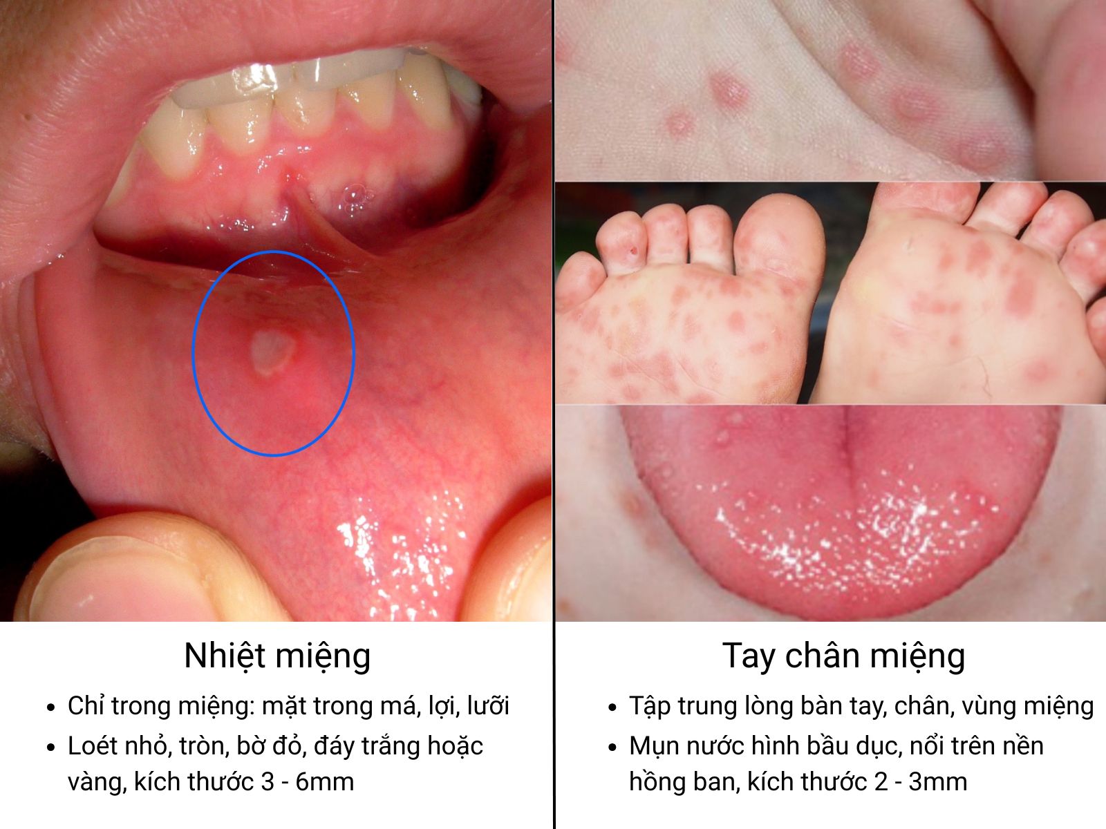 Ba mẹ có thể quan sát kỹ các đặc điểm mụn để phân biệt nhiệt miệng và tay chân miệng
