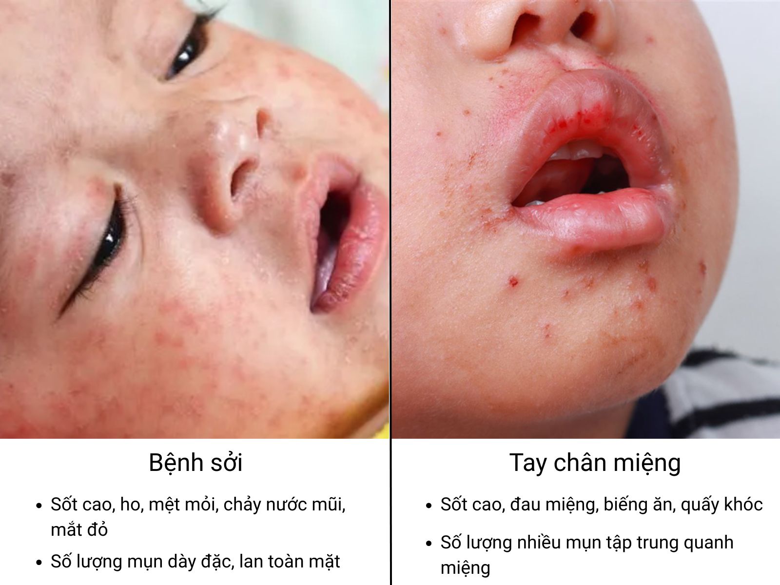 Khác với sởi, bệnh tay chân miệng chỉ nổi mụn nước quanh miệng, tay chân