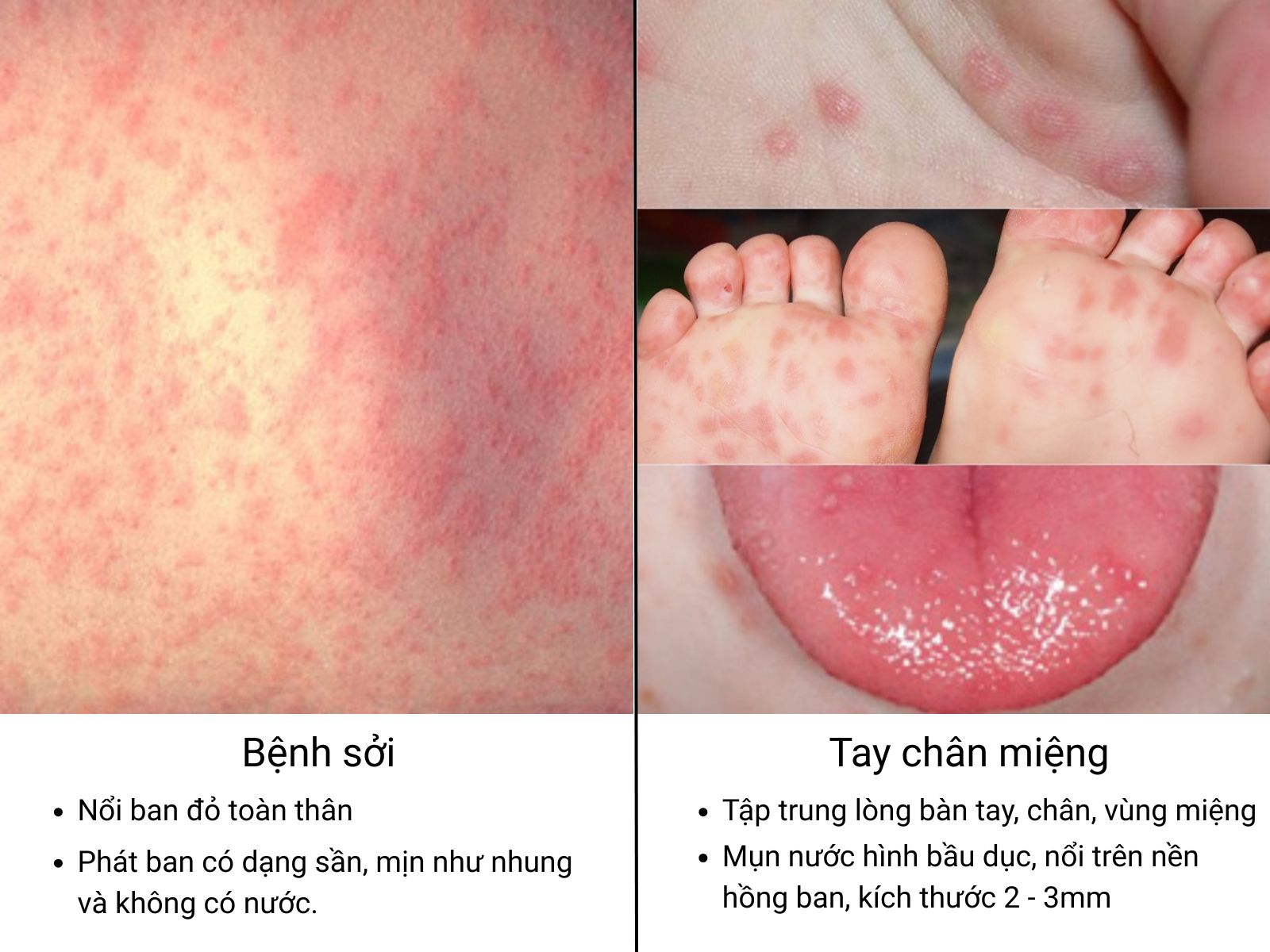 Nhìn nốt mụn ba mẹ có thể phân biệt sởi và tay chân miệng