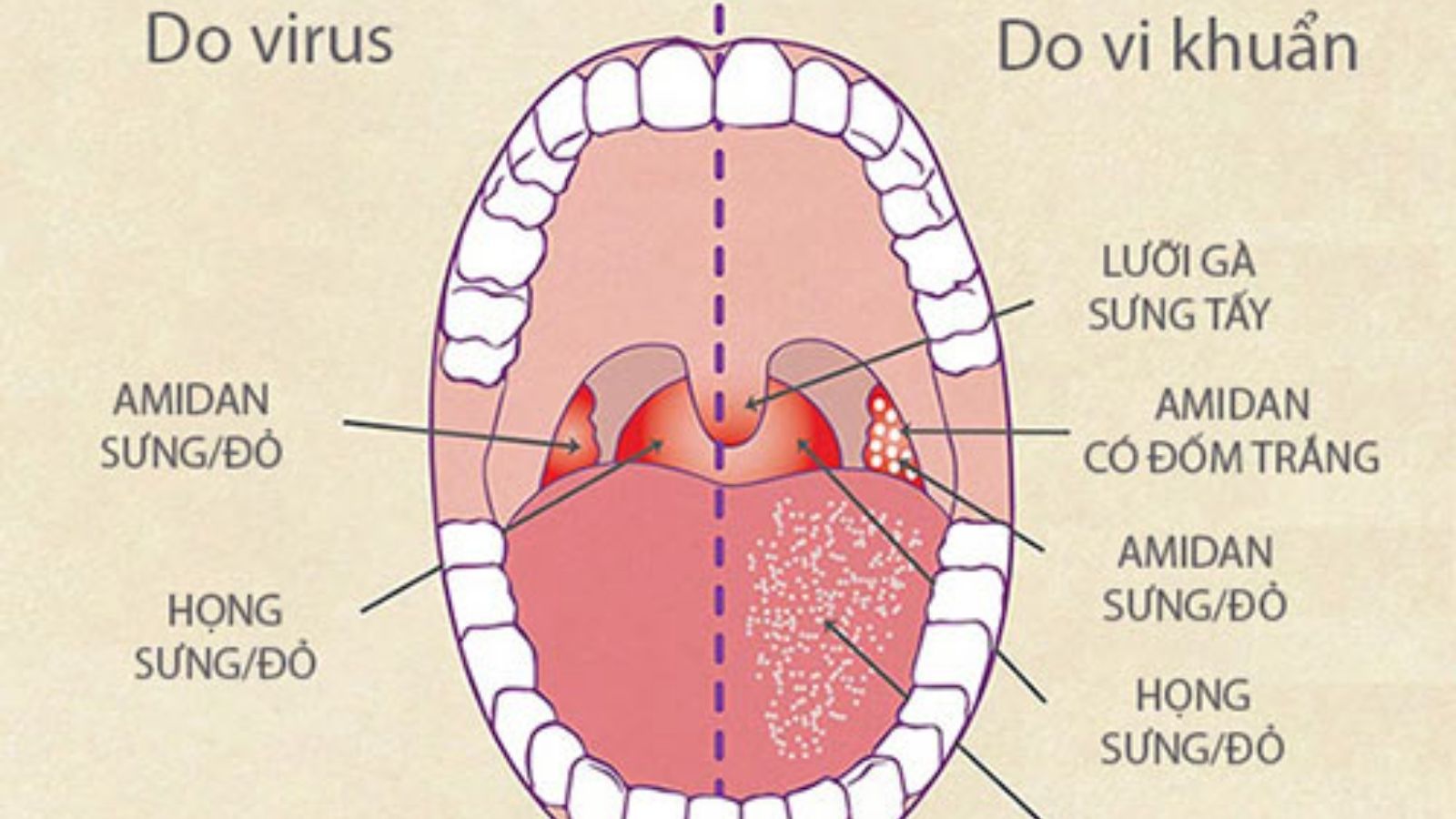 Triệu chứng viêm họng do virus và vi khuẩn có sự khác nhau