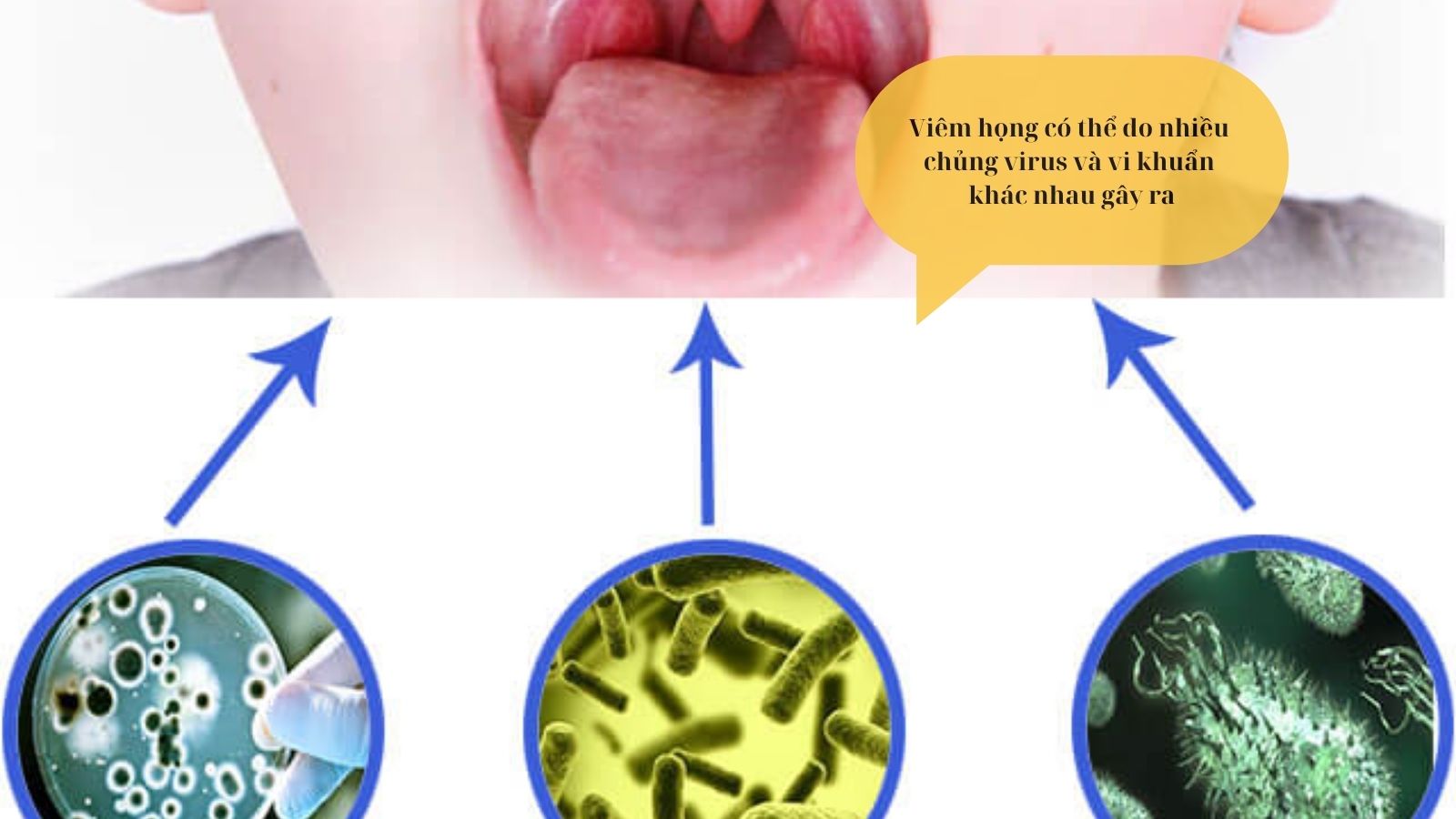 Viêm họng có thể do nhiều chủng virus và vi khuẩn khác nhau gây ra.