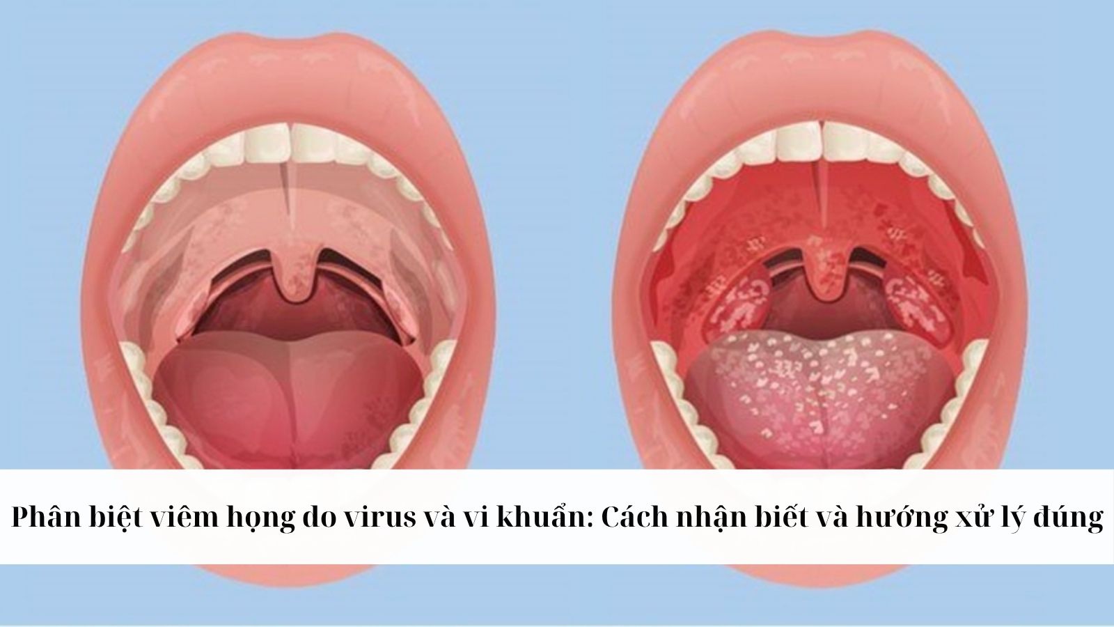 Phân biệt viêm họng do virus và vi khuẩn: Cách nhận biết và hướng xử lý đúng