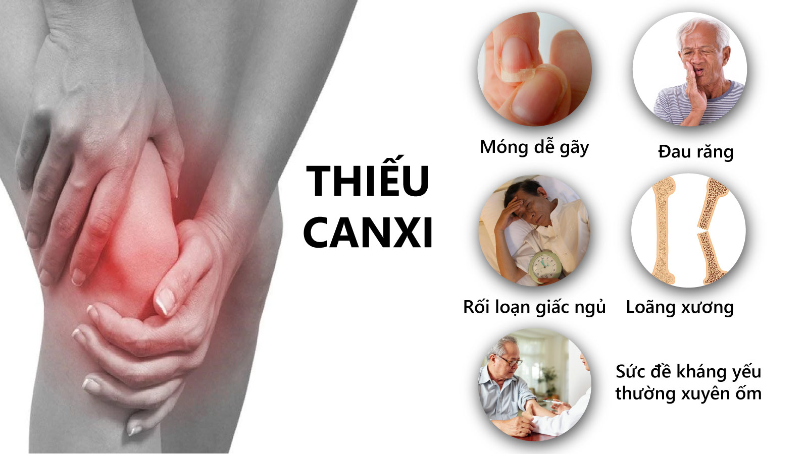 Một số dấu hiệu nhận biết tình trạng thiếu Canxi ở người lớn 