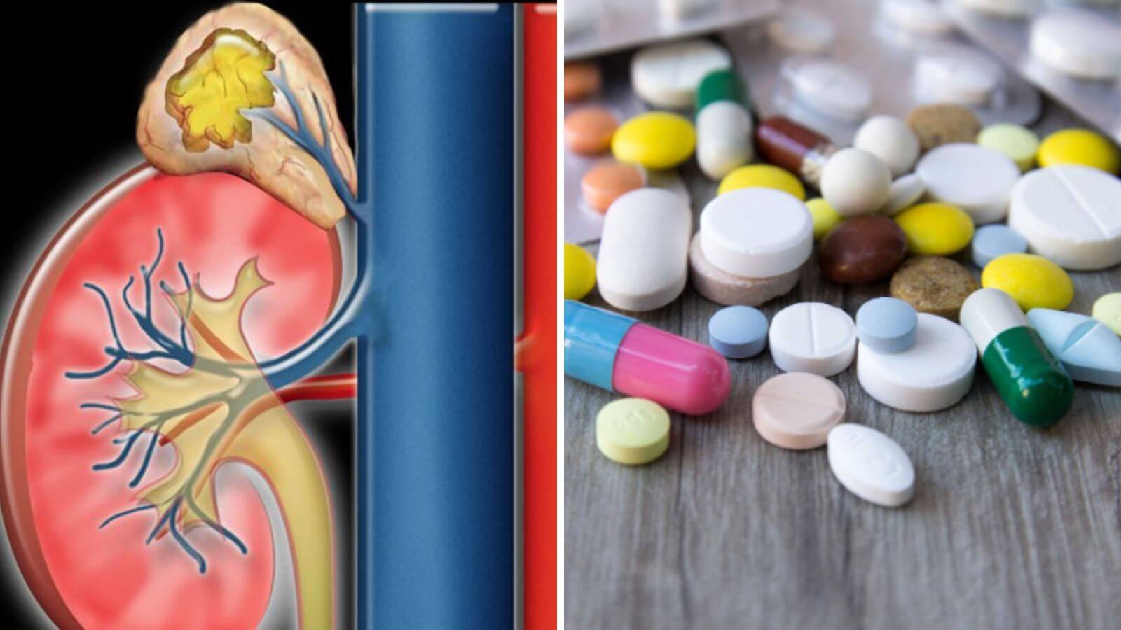 Testosterone cao có thể do bệnh lý hoặc lạm dụng thuốc