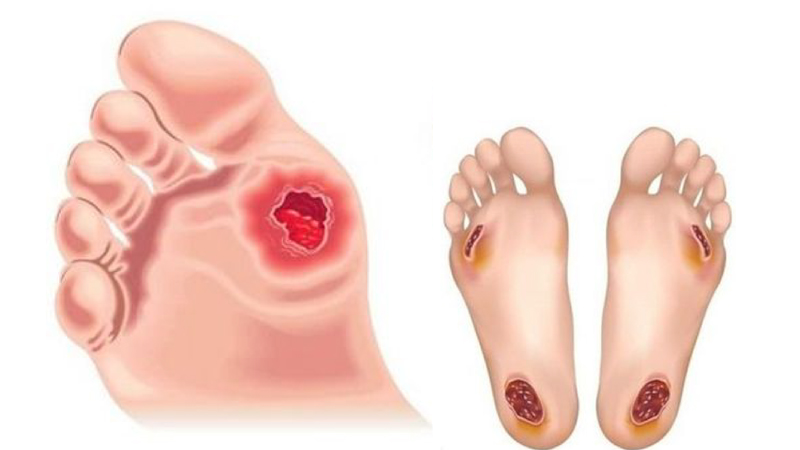 Loét bàn chân ở người tiểu đường: Nguyên nhân và cách điều trị