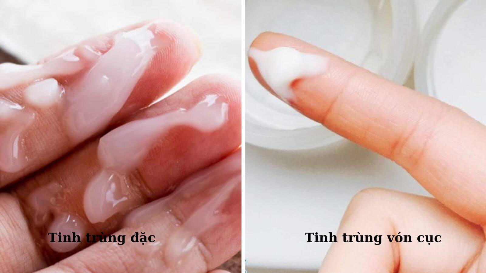 Phân biệt tinh trùng đặc và tinh trùng vón cục