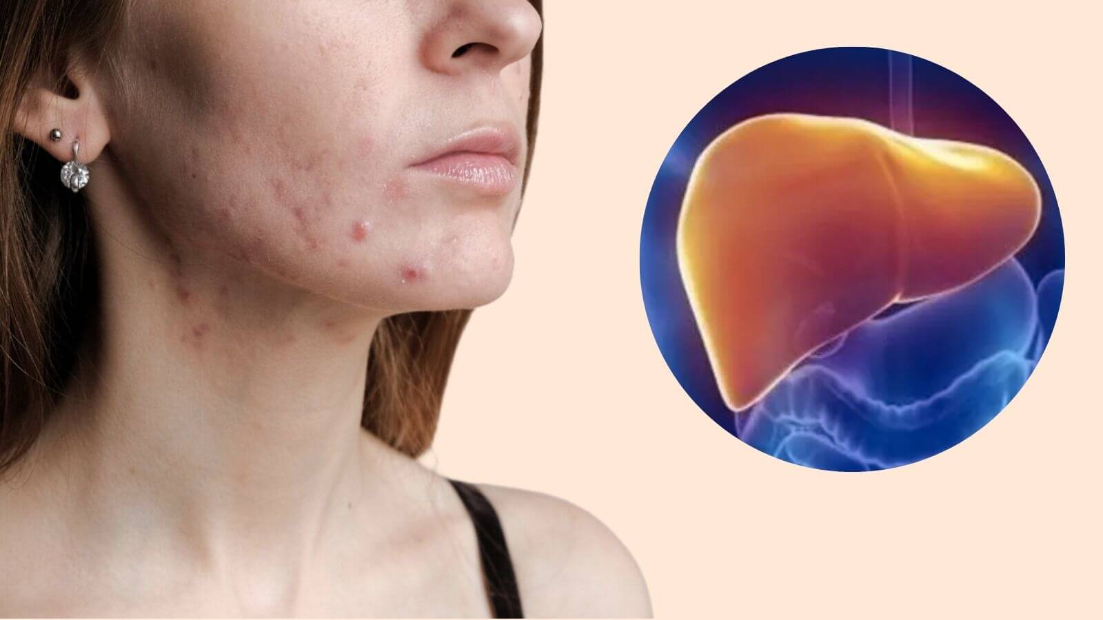 Nổi mụn do gan nhiễm độc