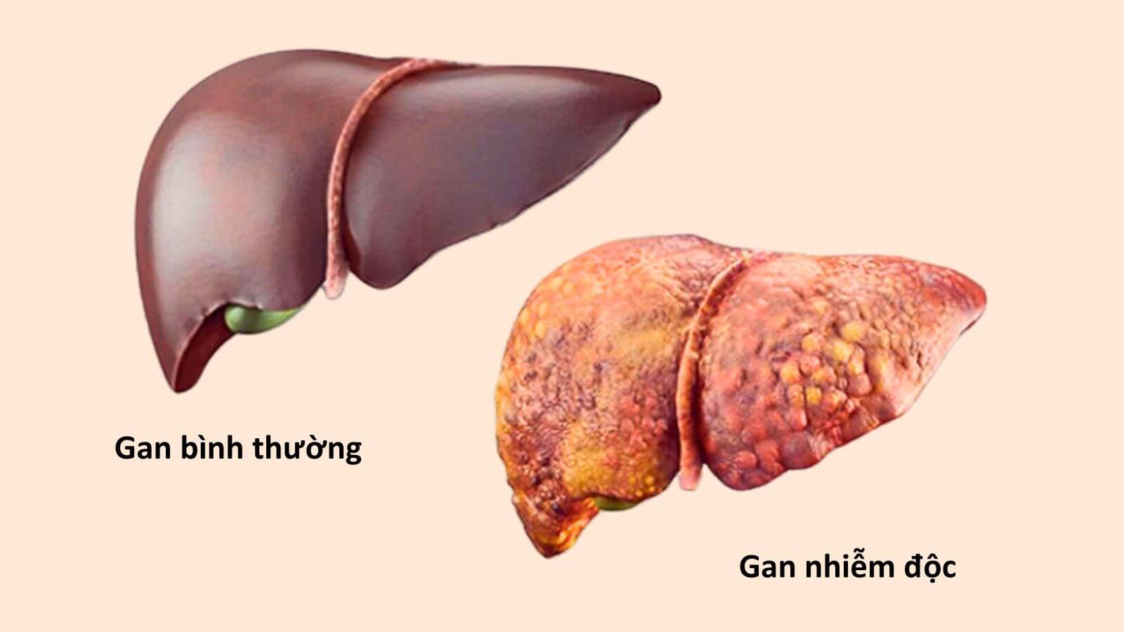 Hình ảnh so sánh gan bình thường và gan bị nhiễm độc