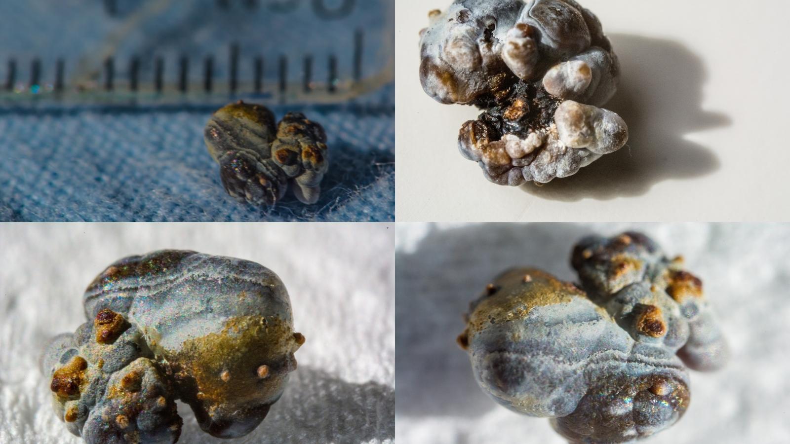 Sỏi thận dễ dẫn đến tiểu đường type 2