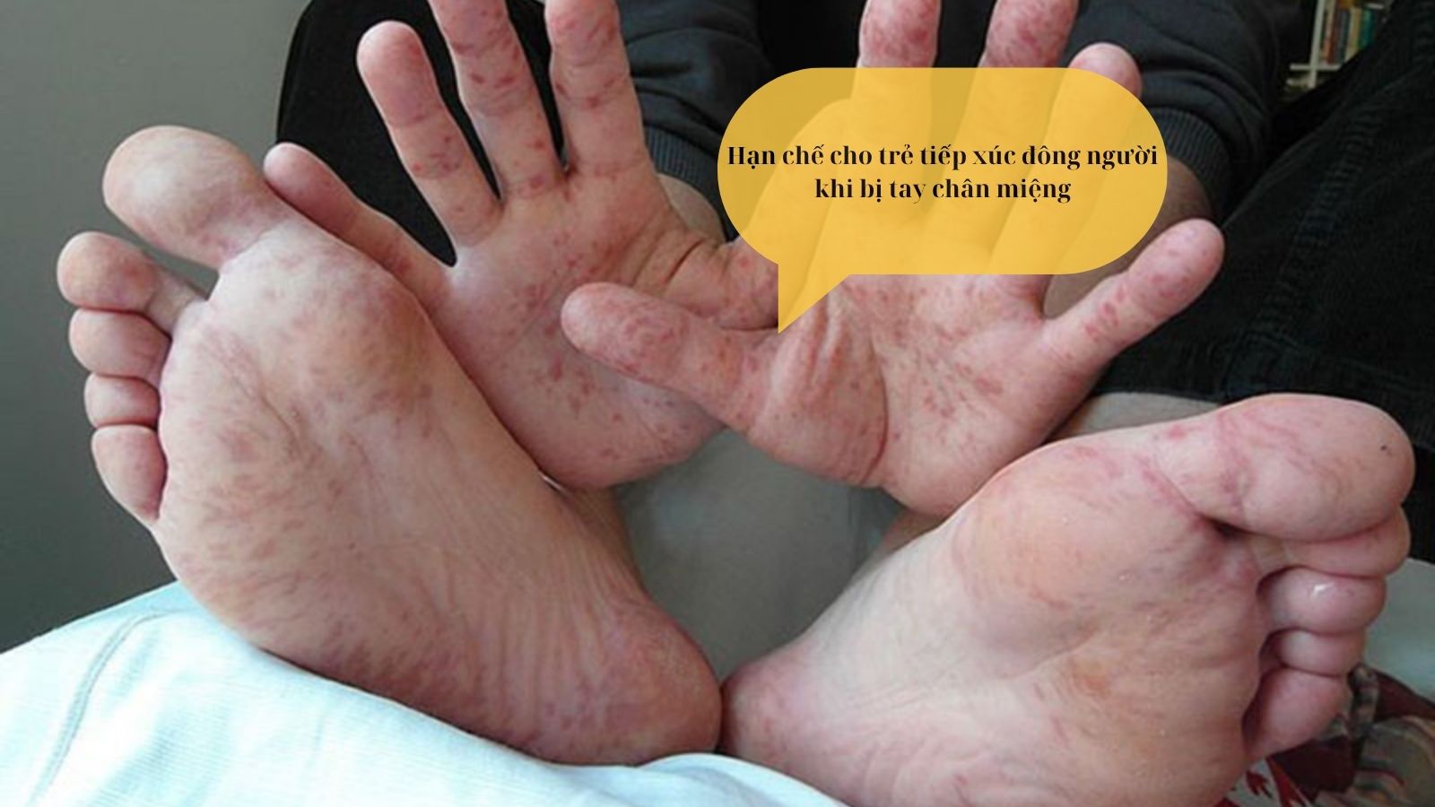 Khi bị tay chân miệng kiêng gì? Mẹ nên kiêng cho bé tiếp xúc nơi đông người
