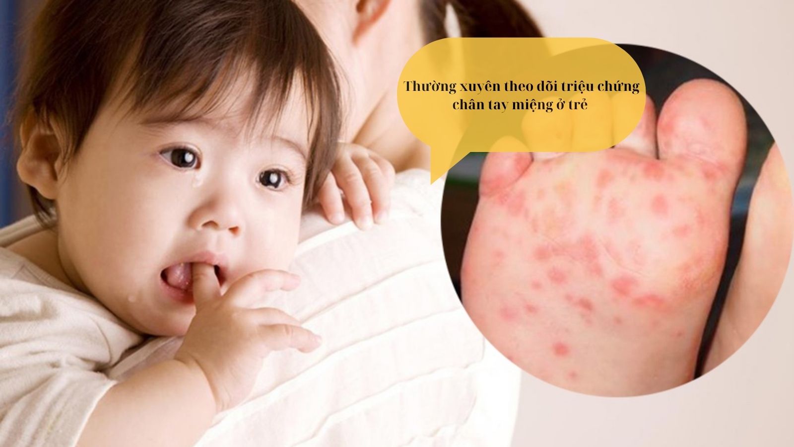 Cần theo dõi sát sao triệu chứng chân tay miệng ở trẻ để có biện pháp kịp thời