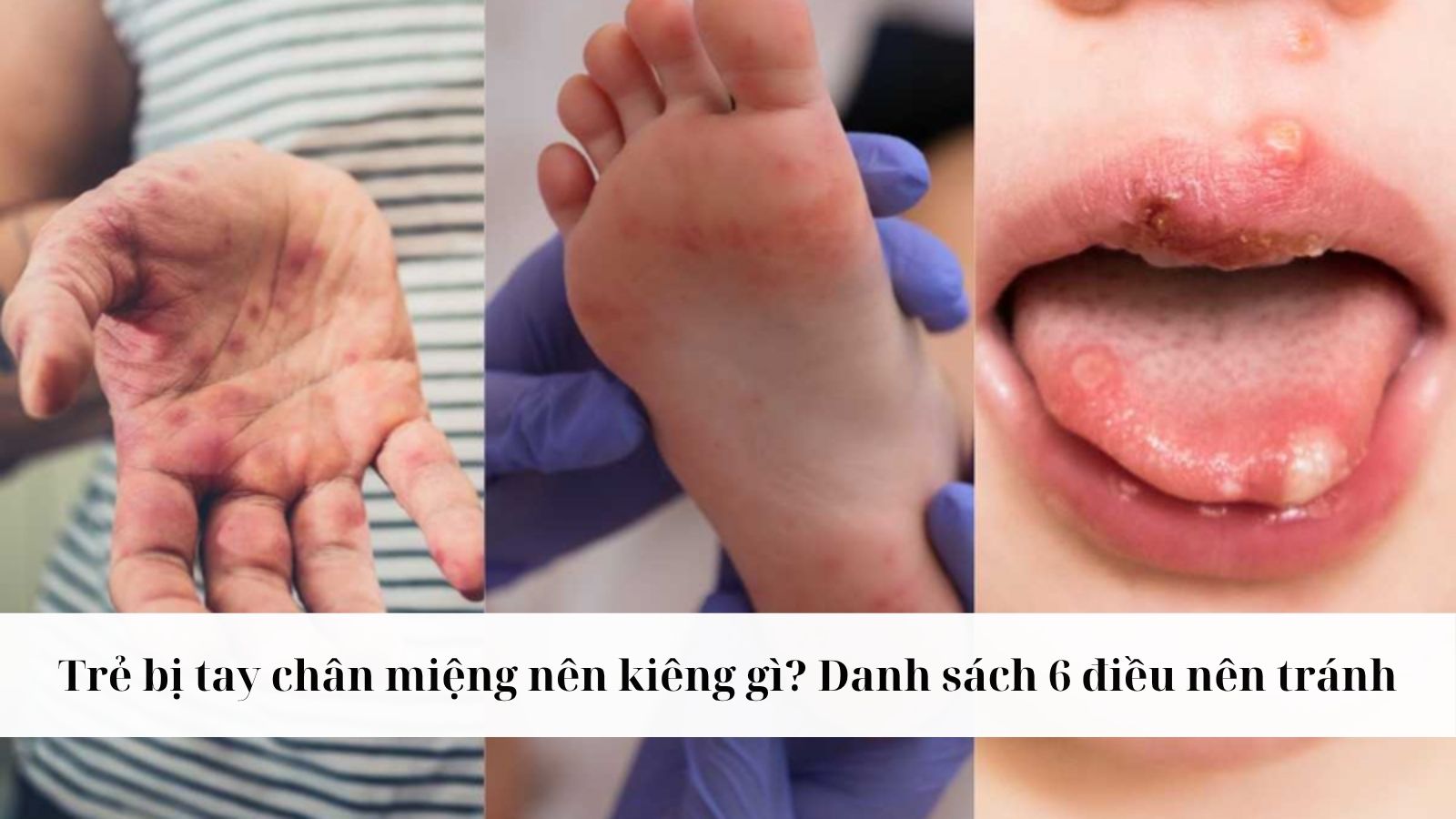 Trẻ bị tay chân miệng nên kiêng gì? Danh sách 6 điều nên tránh