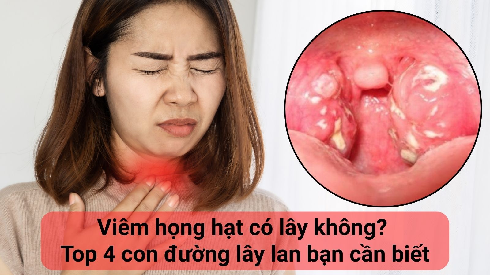 Viêm họng hạt có lây không? Top 4 con đường lây lan bạn cần biết
