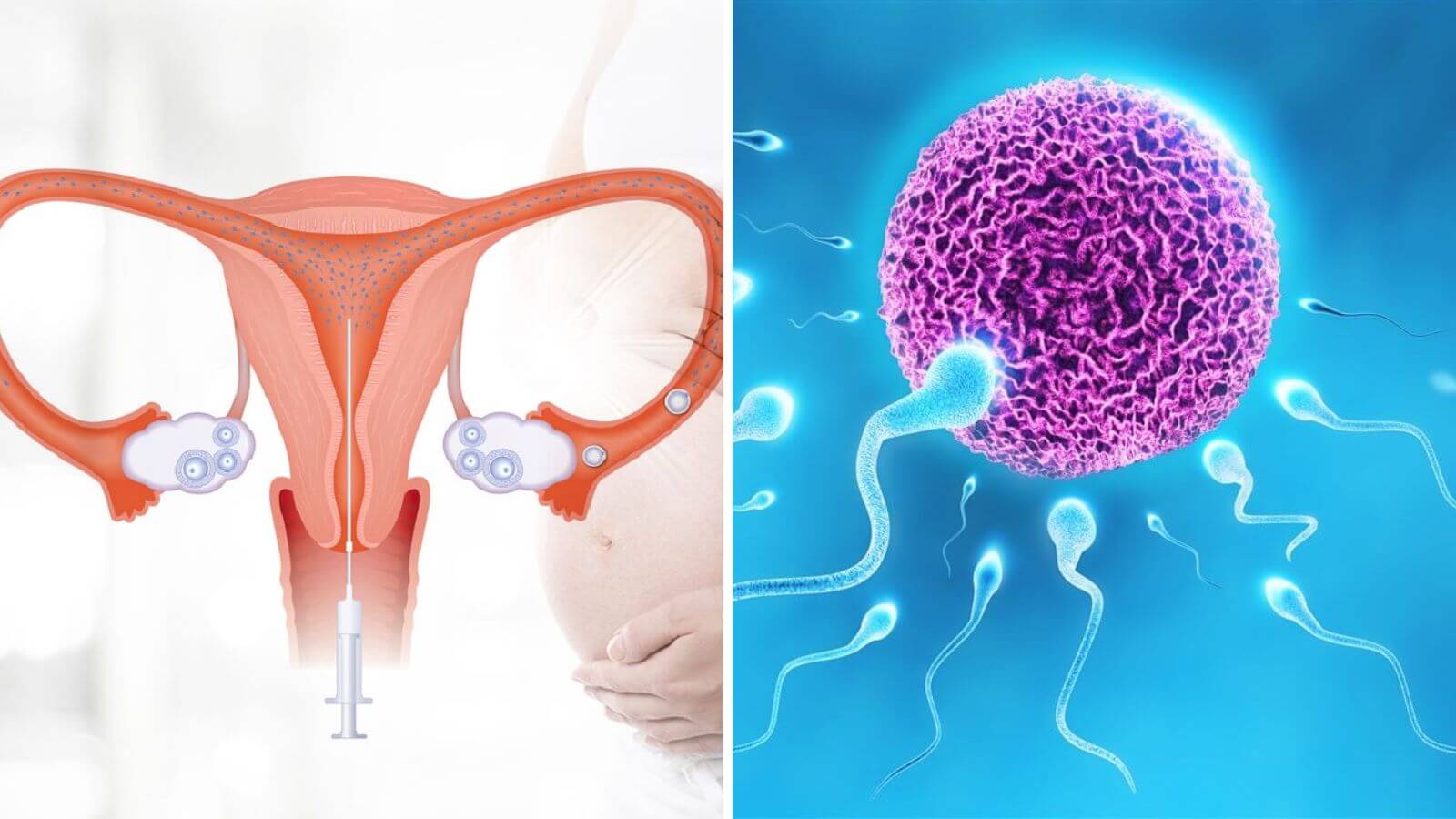 Phương pháp bơm tinh trùng vào tử cung IUI đơn giản, thực hiện nhanh gọn với chi phí thấp