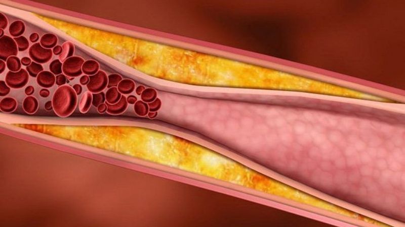 Xơ vữa mạch máu là một trong những biến chứng tiểu đường gây suy giảm tuổi thọ.