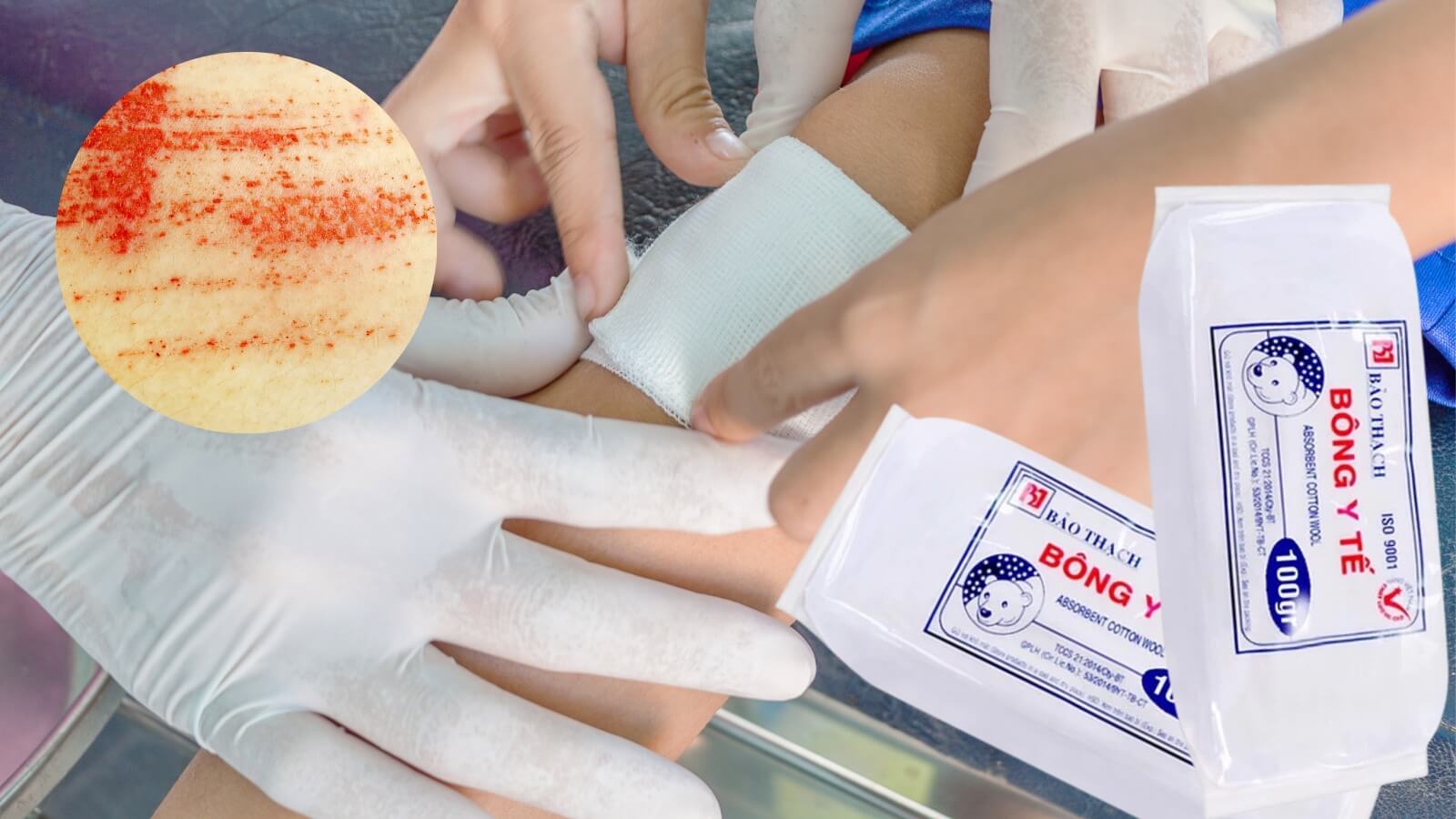 Bông y tế Bảo Thạch dùng để thấm máu, cầm máu hay sát trùng vết thương.