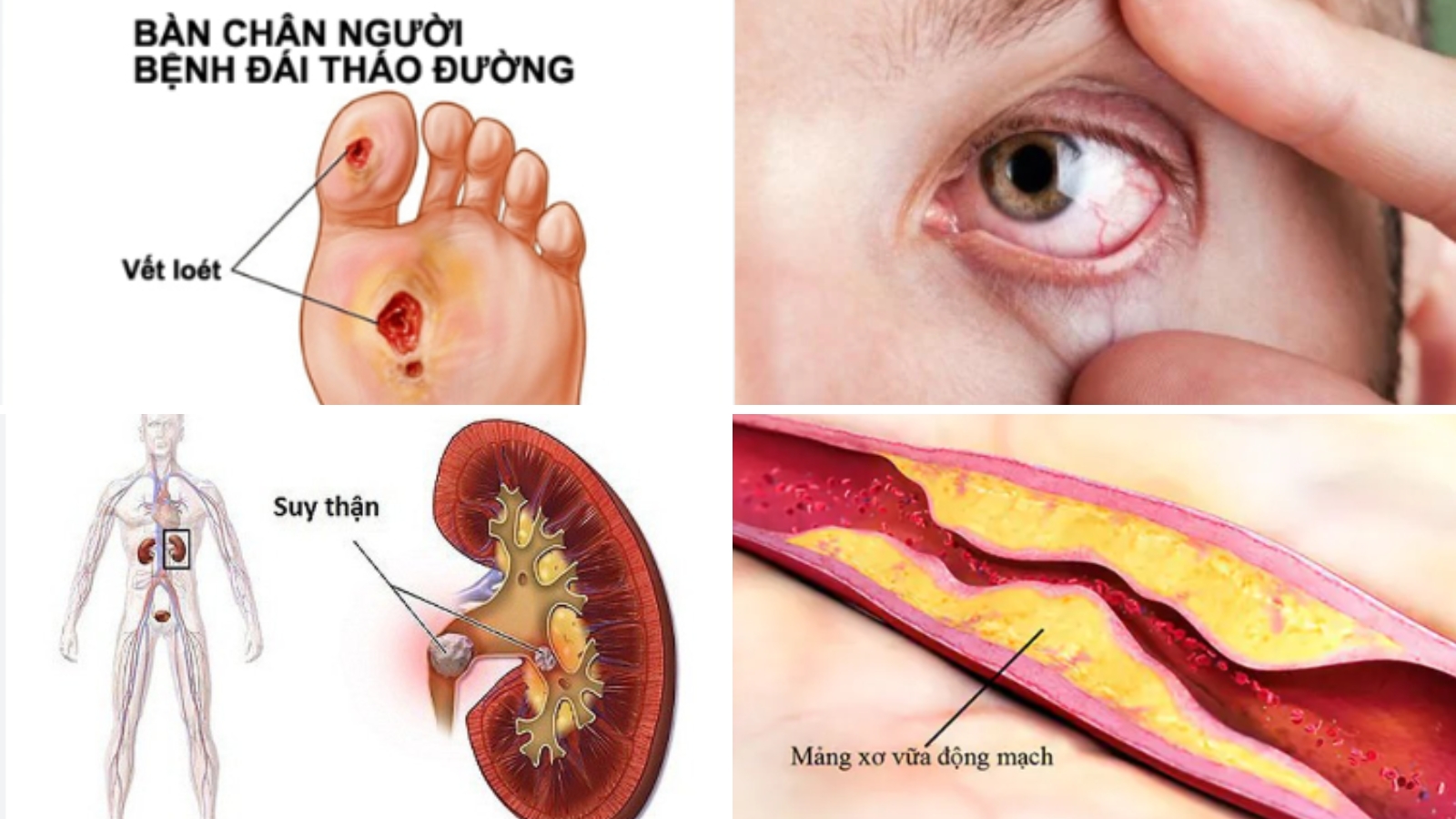 Một số biến chứng của bệnh đái thái đường