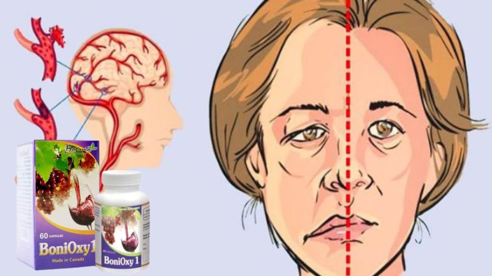 BoniQxy1 ngừa xơ vữa mạch máu, tai biến