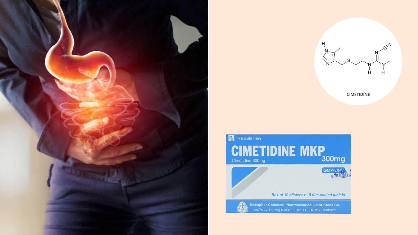 Cimetidine MKP 300mg chứa thành phần chính Cimetidin, có công dụng hiệu quả trong điều trị ngắn hạn loét dạ dày